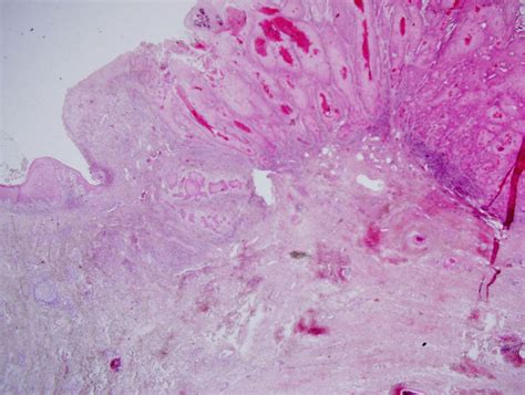 Photomicrograph Of Microinvasive Squamous Cell Carcinoma Of The Vulva