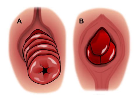 Rectal Prolapse Expanded Version Ascrs