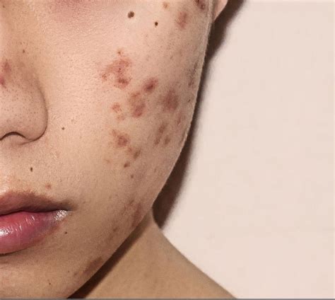 Acne Scars Causes Prevention And Treatment Waxelene