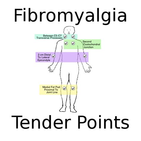 Fibro Tender Points Diagram