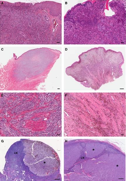 Similarities Between Histopathological Features Of Mucosal Melanomas In