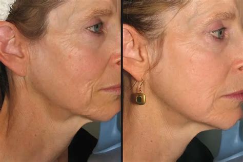 Skin Tightening Laser Treatment How It Works Pros And Cons