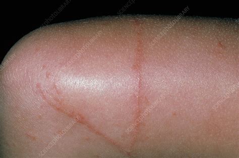 Larva Migrans Skin Rash Due To Hookworm Larvae Stock Image M2000098