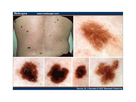 Highlights In Melanoma Research And Treatment