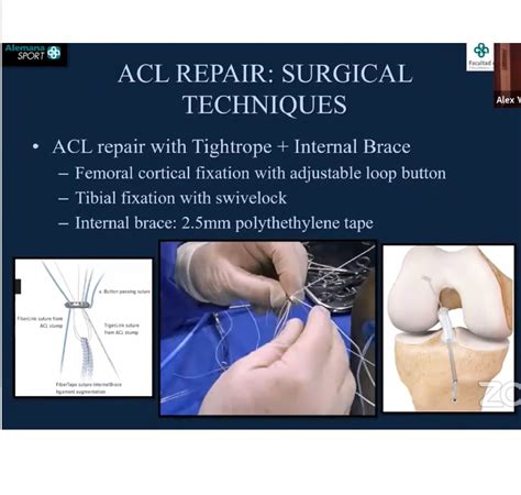 Acl Repair For Femoral Avulsions —