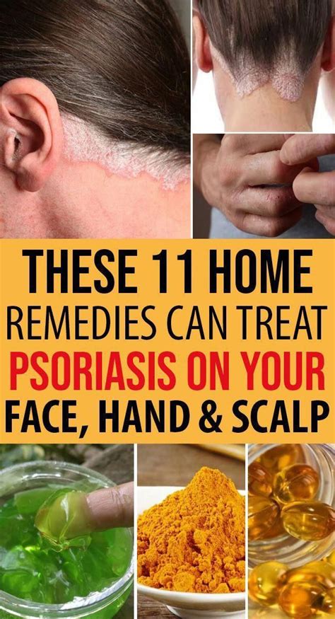 5 Scalp Psoriasis Home Treatment Ideas Huomonan