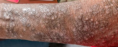 Pruritic Papular Eruption — Black And Brown Skin