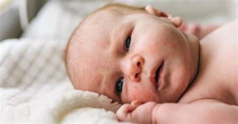 Baby Acne Symptoms Causes And Treatment