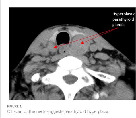 Figure 1 From Endoscopic Total Parathyroidectomy Via Anterior Chest