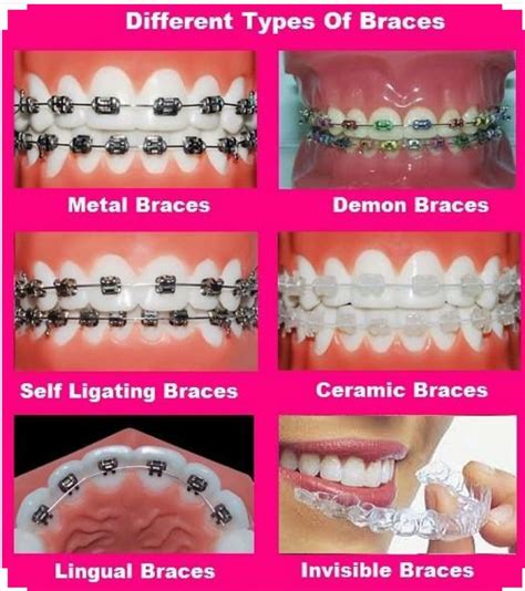 Braces Color Wheel On Teeth