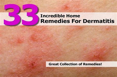 33 Incredible Home Remedies For Dermatitis