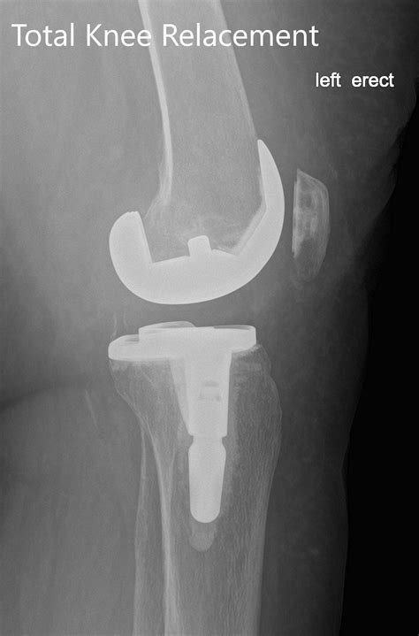 Case Study Left Total Knee Replacement In 62 Yr Old Male