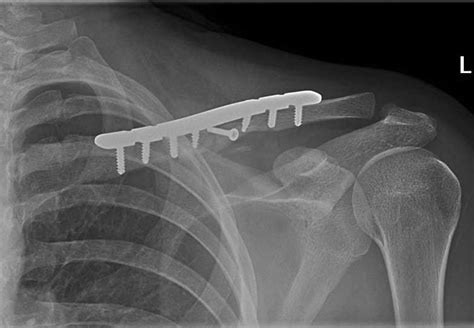 Fracture Clavicle Open Reduction Internal Fixation Done At Harini