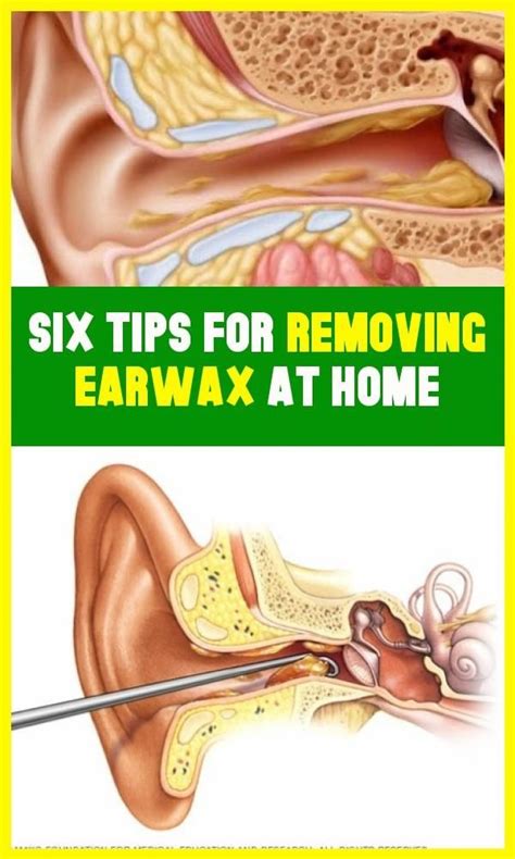 Six Tips For Removing Earwax At Home In 2020 Ear Wax Ear Wax Removal
