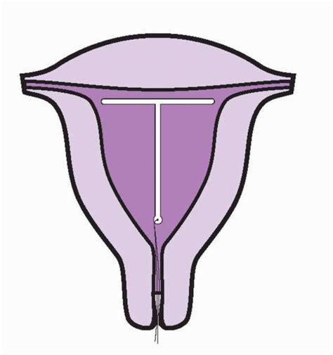 Intrauterine Contraception Obgyn Key