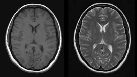 In the t1 type of relaxation, atomic nuclei come to thermal equilibrium in the magnetic field. MRI - Radiology at St. Vincent's University Hospital