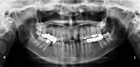 Panoramic Radiograph Showing Impacted Maxillary Third Fourth And