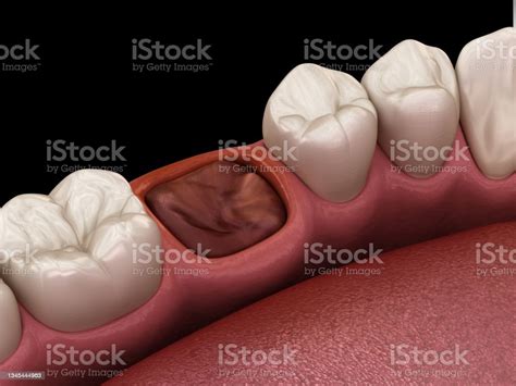 The Blood Clot Seals Off The Tooth After Extraction Medically Accurate