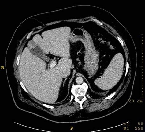 Adenosquamous Carcinoma Of The Gallbladder Eurorad