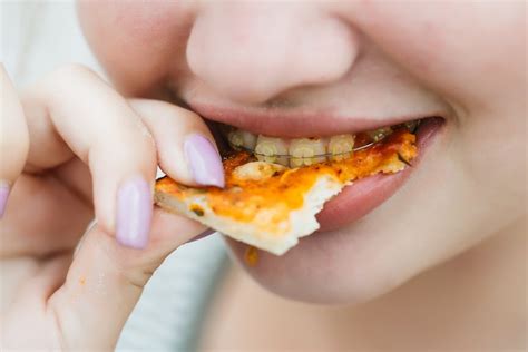 Foods To Avoid And Eat With Braces Shinagawa Dental Blog