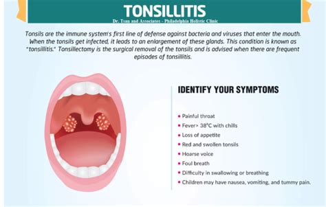 Treatment Of Tonsillitis Philadelphia Holistic Clinic Dr Tsan