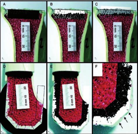 A Measurement Area For The Tibial Cement Mantle Adjusted On Cortical