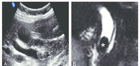 Common Bile Duct Stone A Ultrasound Image Showing Large Stone Arrow