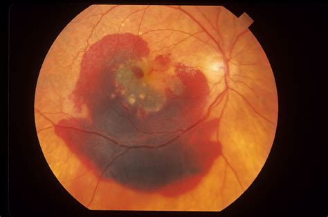 Macular Degeneration Caused By Aging Or Maculopathy Can Be Treated