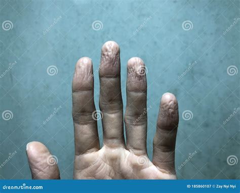 Hand Fissures Stock Photos Free Royalty Free Stock Photos From