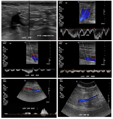 Doppler Ultrasound Scan For The Left Lower Limb A And B Left Common