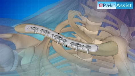 Broken Collarbone Surgery 3d Video Plates And Screws Pins Bone Graft