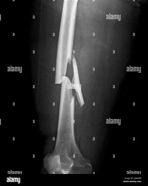 Comminuted Femur Fracture X Ray Stock Photo Alamy