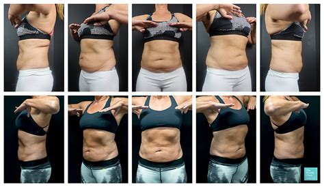 Belly Fat Freezing With Coolsculpting Coolsculpting Stomachabdomen Before And After Photos