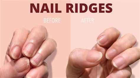 Ridges In Fingernails Types Causes And Treatment Page 6 Entirely