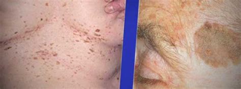 Causes And Treatment Of Brown Skin Spots Pictures And