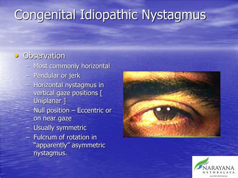 Ppt Management Of Nystagmus The Ophthalmologists Perspective