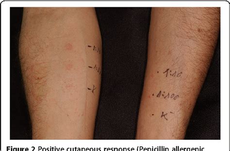 .among patients with skin rash following amoxicillin treatment within infectious mononucleosis. Figure 2 from Amoxicillin rash in patients with infectious ...