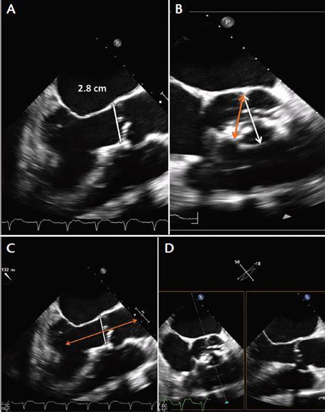 Cardiac Interventions Today Echocardiographic Aortic Annulus Sizing