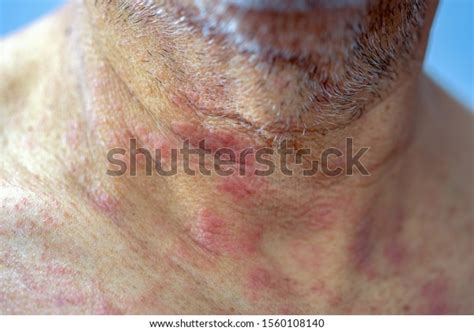 Extreme Closeup Photography Atocpic Dermatitis Symptoms Stock Photo