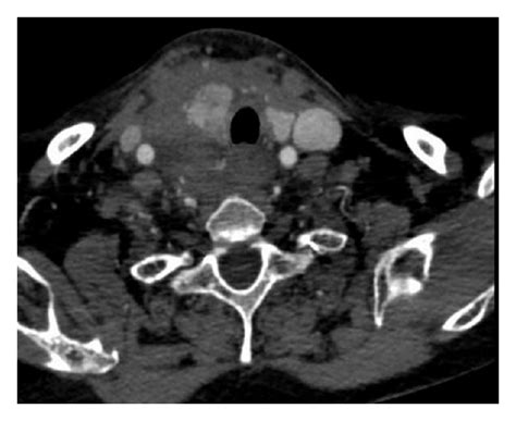 Spontaneous Neck Hematoma In A Patient With Fibromuscular Dysplasia A