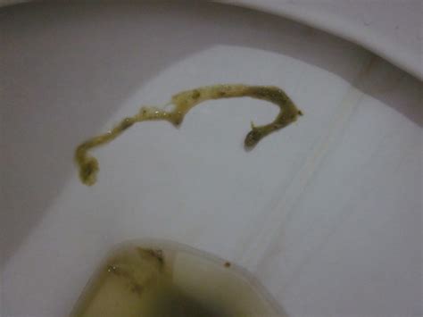 Intestinal Worms In Humans Poop