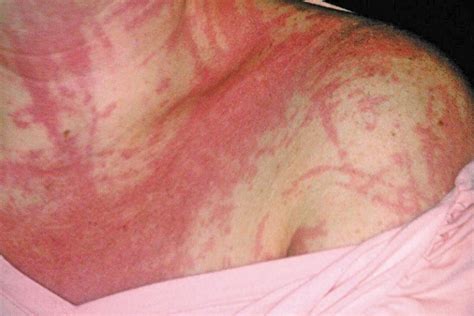 Serious Conditions That Rashes And Hives Can Indicate Page