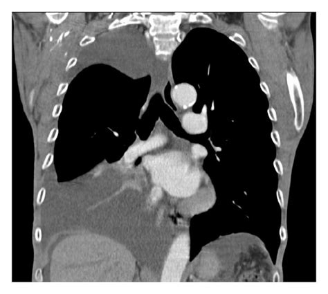 Ct Scan Of The Chest Without Intravenous Contrast Coronal View