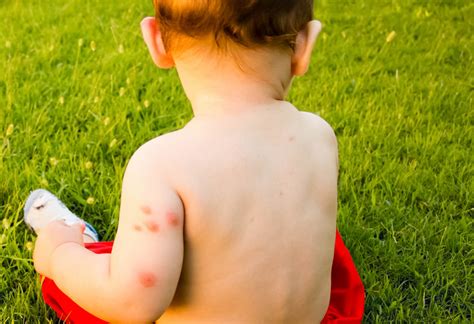 What Every Mom Needs To Know About Bed Bug Bites On Babies