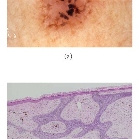 Pdf Superficial Type Of Multiple Basal Cell Carcinomas Detailed