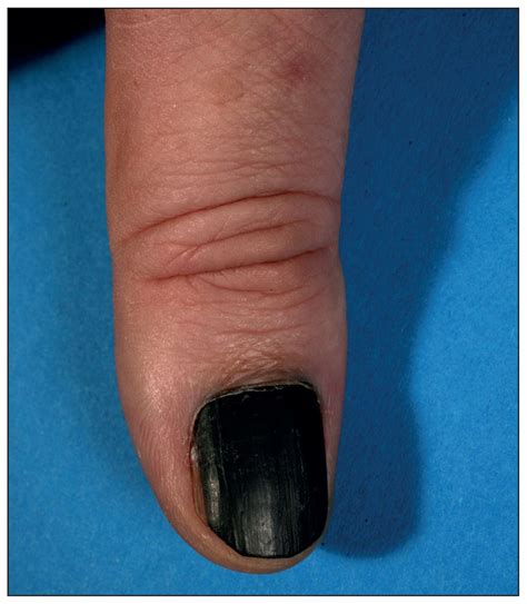Subungual Melanoma Fingernail