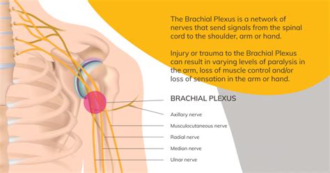 Minster Law Take Proactive Approach To Complex Brachial Plexus Injuries