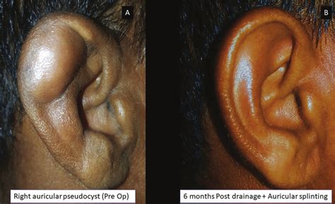 Localized Pseudocyst Of Right Ear Panel A And Complete Resolution