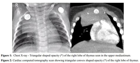 Thymic Sail Sign International Journal Of Clinical And Medical Images