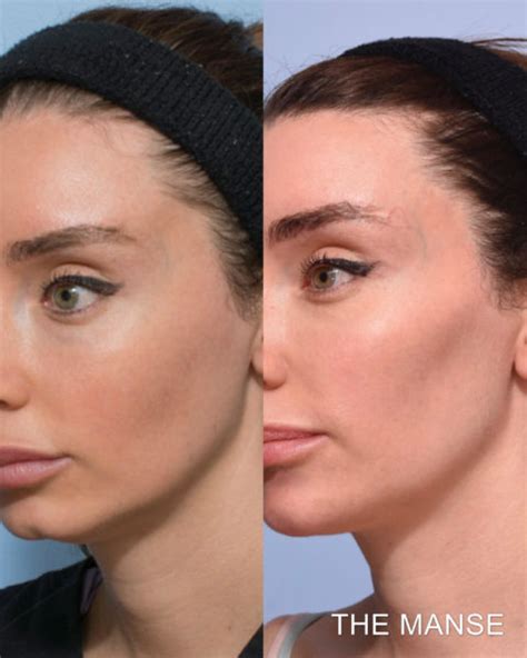 Cheek Fillers Before And After Sydney Dermal Filler Clinic